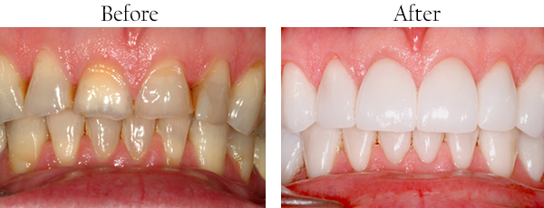 Corona dental images